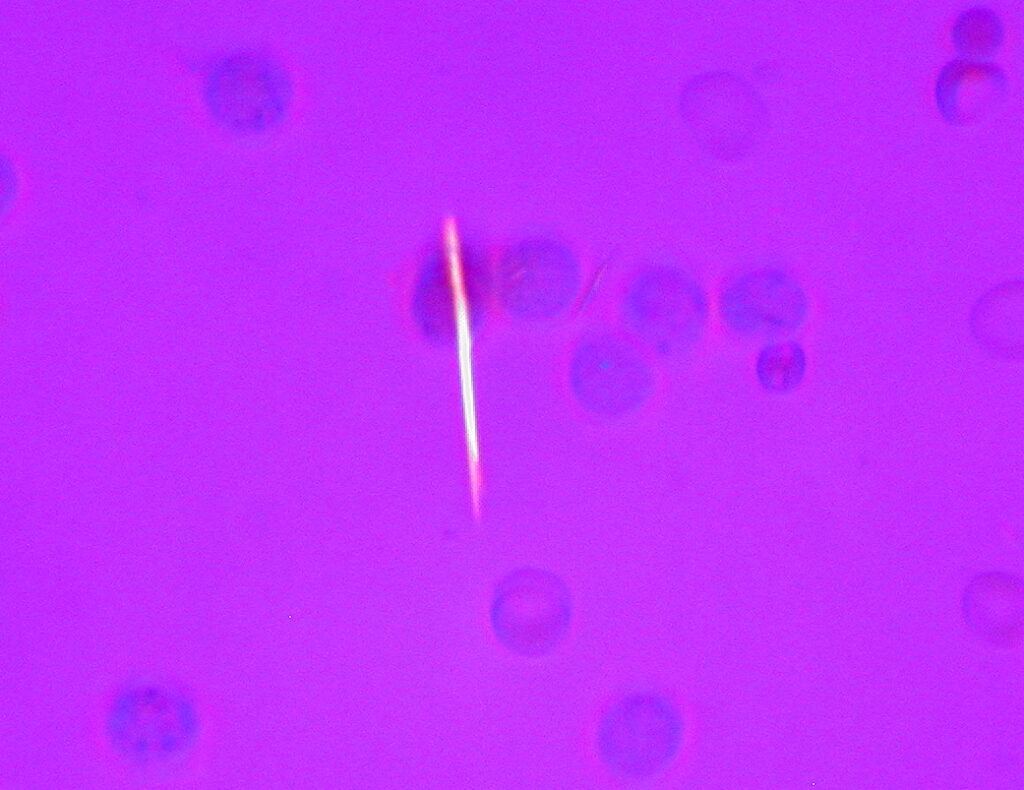 Gout, monosodium urate crystals in gout
