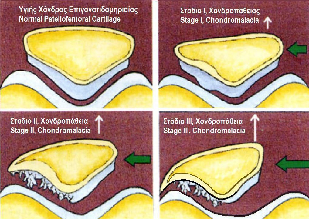 Grading - Outerbridge, Collins, SFA, stages of chondromalacia of the patellofemoral joint