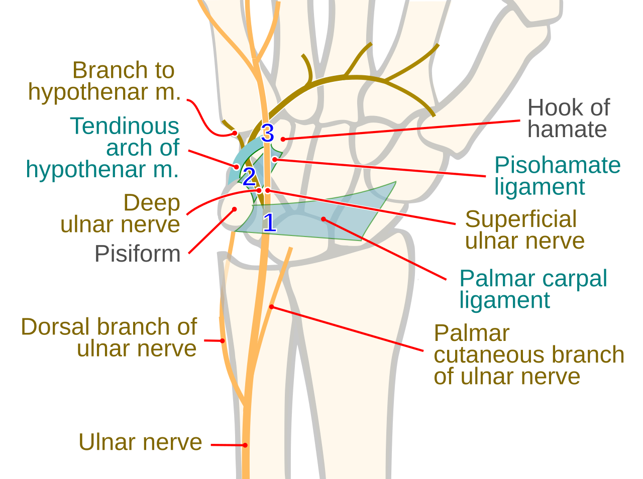 Diagram of the zones of the Guyon canal at the wrist with the ulnar nerve branches, hypothenar muscles and pisiform labelled