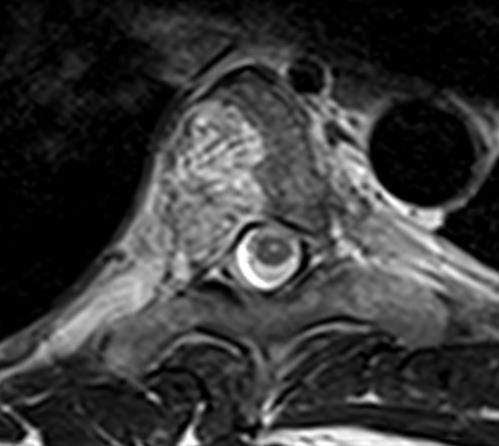 Haemangiomas, imaging of a vertebral haemangioma
