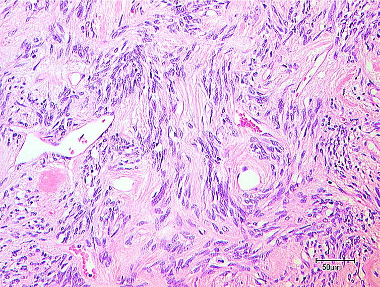 Haemangiopericytoma, histology of solitary fibrous tumour, the current term for haemangiopericytoma