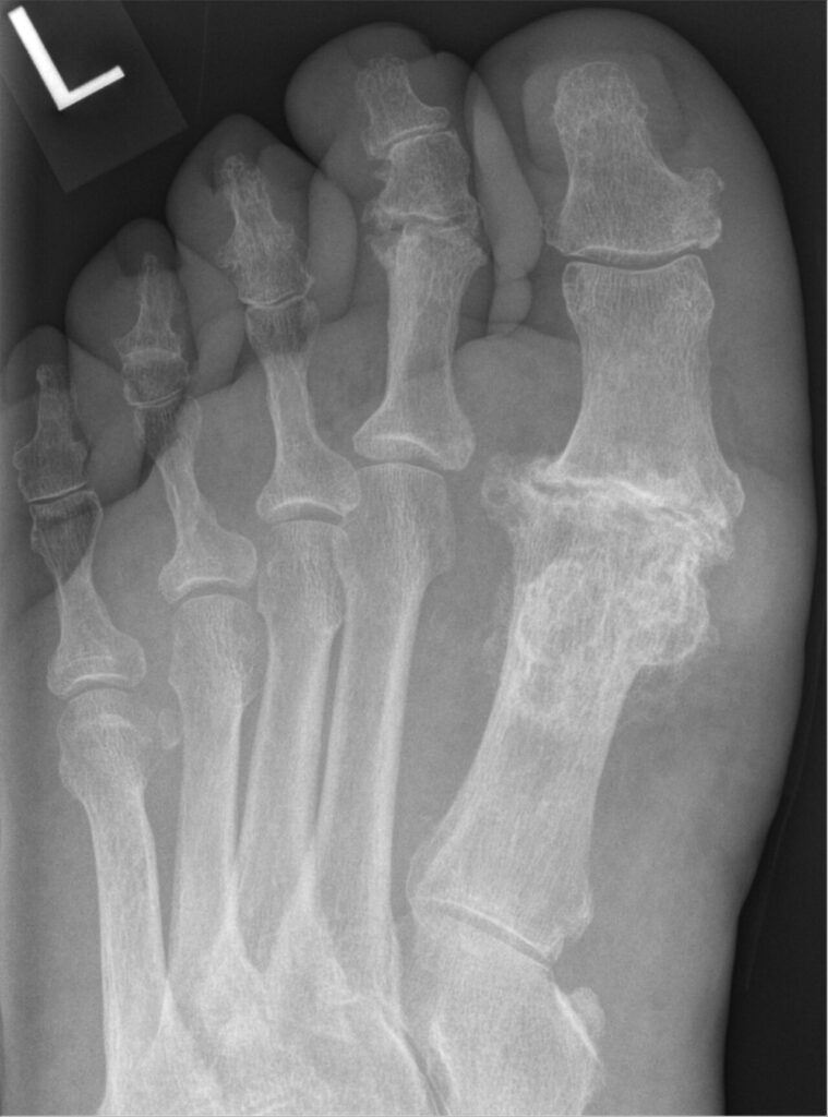 Hallux Rigidus, radiograph of hallux rigidus