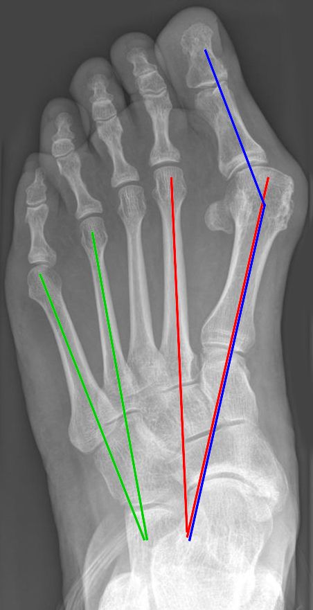 Hallux Valgus, radiograph showing hallux valgus and intermetatarsal angle measurement