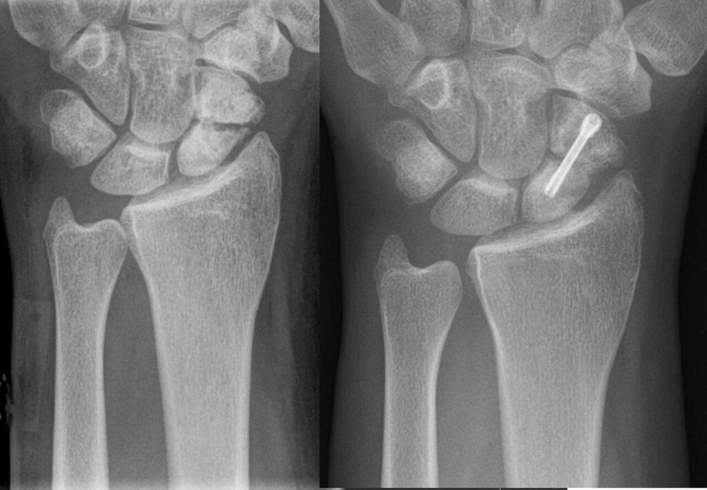 Hand iSAWE 3, wrist radiographs