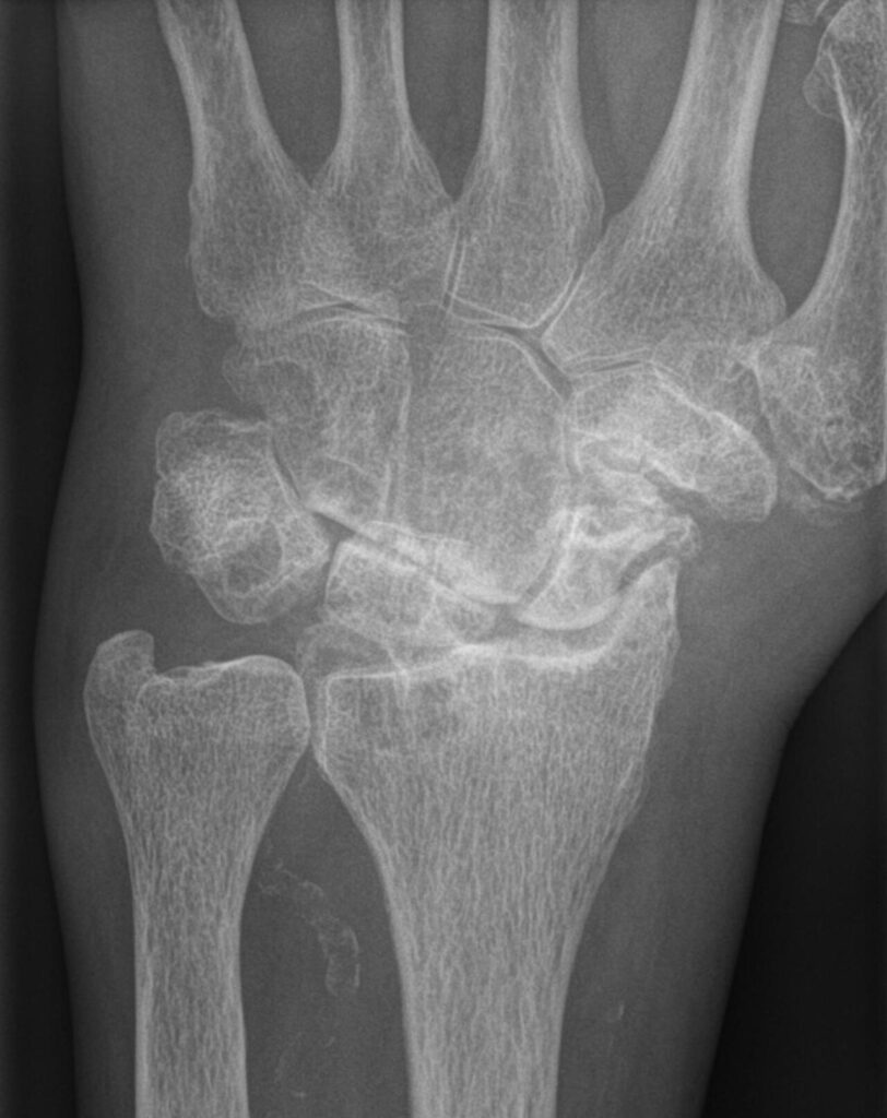 Hand iSAWE 9, PA radiograph of the wrist