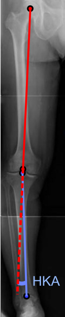 High Tibial Osteotomy, long leg radiograph showing the hip knee ankle angle