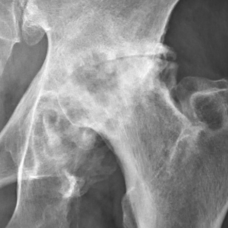 Hip iSAWE 1, ap radiograph of the hip
