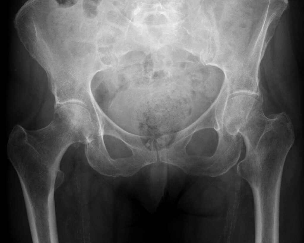 Hip iSAWE 11, AP radiograph of the pelvis