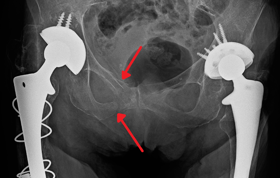 Hip iSAWE 17, AP radiograph of the pelvis
