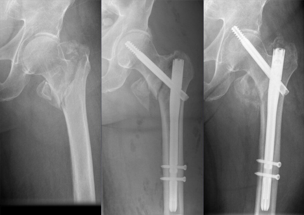 Hip iSAWE 18, AP radiographs of the hip, before and after fixation