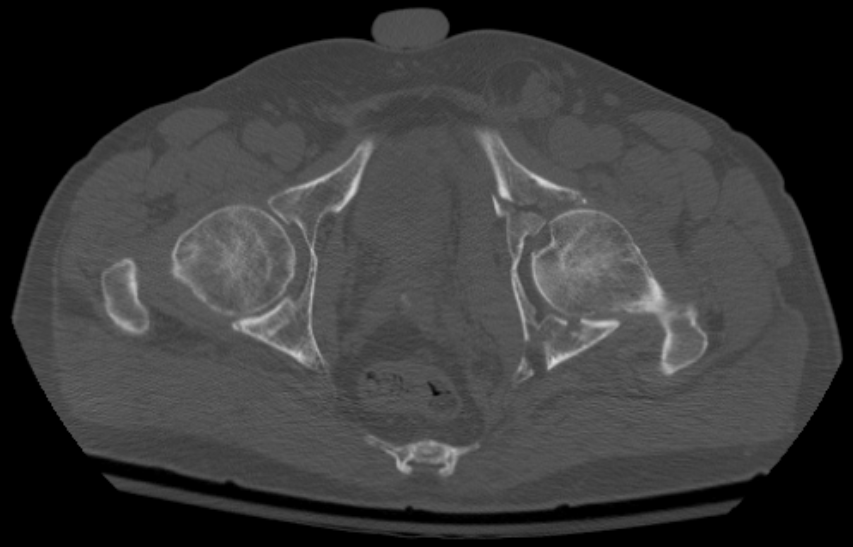 Hip iSAWE 19, axial CT of the pelvis