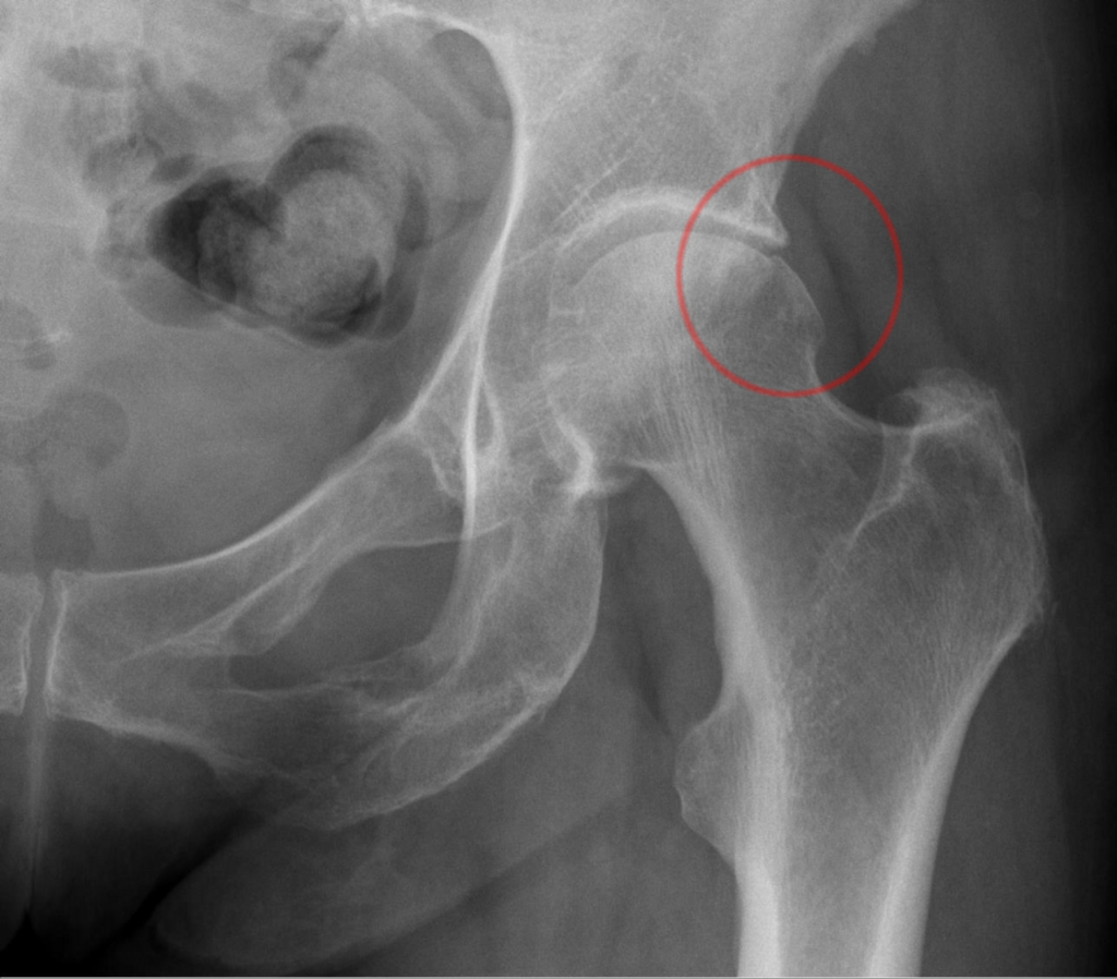 Hip iSAWE 2, ap radiograph of the hip