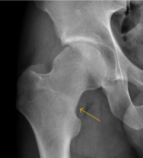 Hip iSAWE 20, AP radiograph of the hip