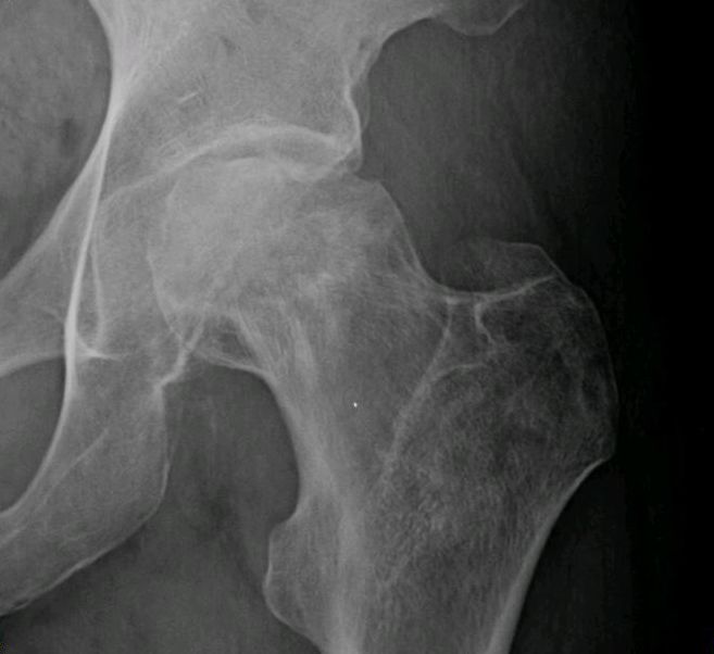 Hip iSAWE 3, ap radiograph of the hip