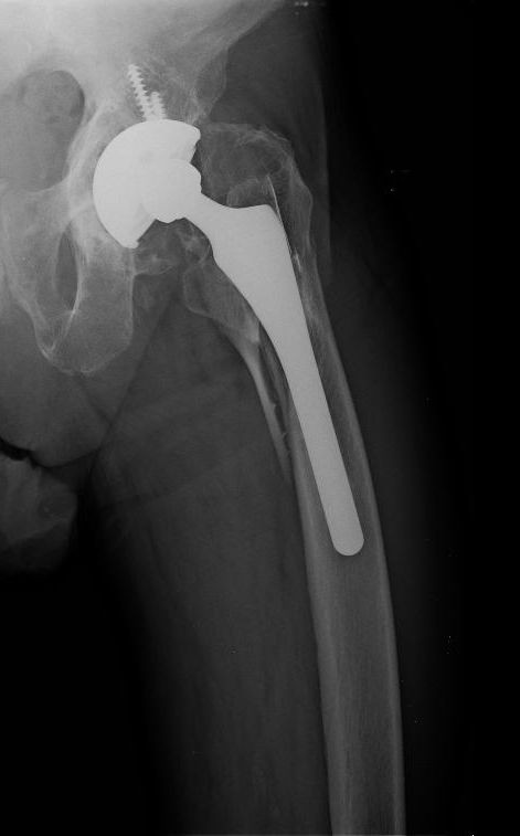 Hip iSAWE 6, ap radiograph of the femur