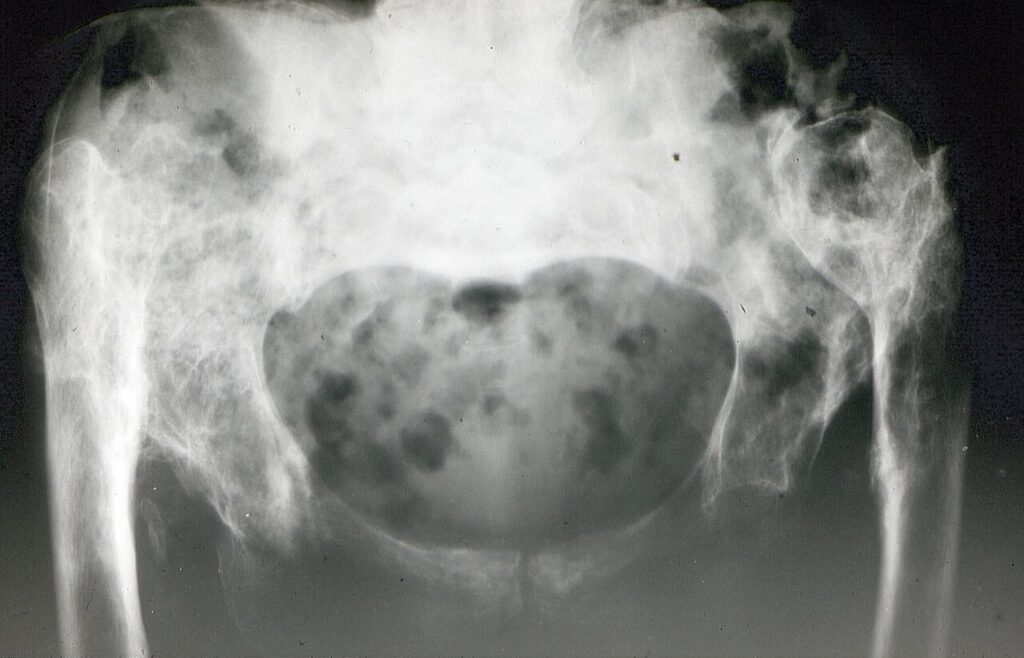 Hip iSAWE 7, ap pelvis radiograph