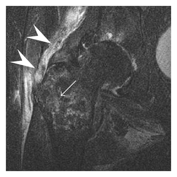 Hip iSAWE 8, coronal stir mri of the hip
