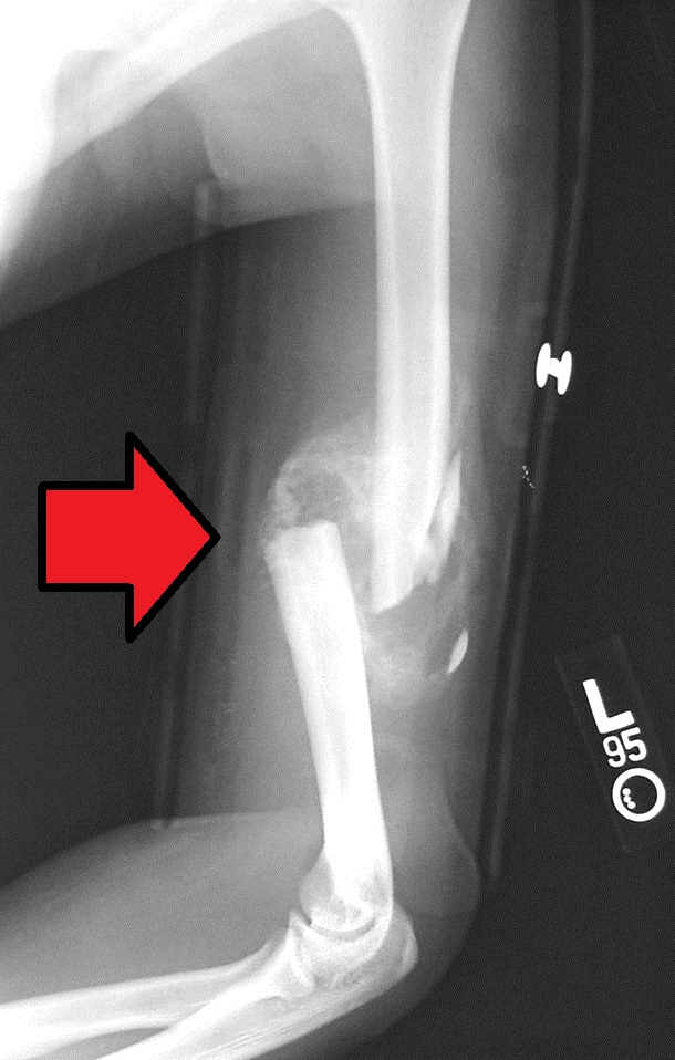 Shoulder Elbow iSAWE 14, radiographs of the humerus