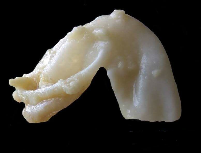 Hydatid Disease, gross appearance of a hydatid cyst