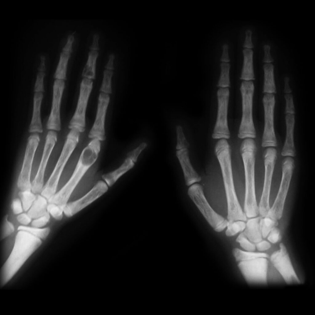 Hyperparathyroidism, hand radiographs showing brown tumours in hyperparathyroidism
