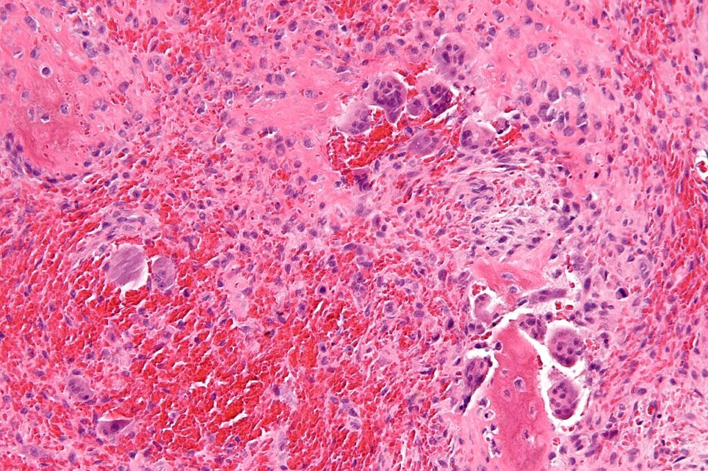 Hyperparathyroidism, histology of a brown tumour at high magnification