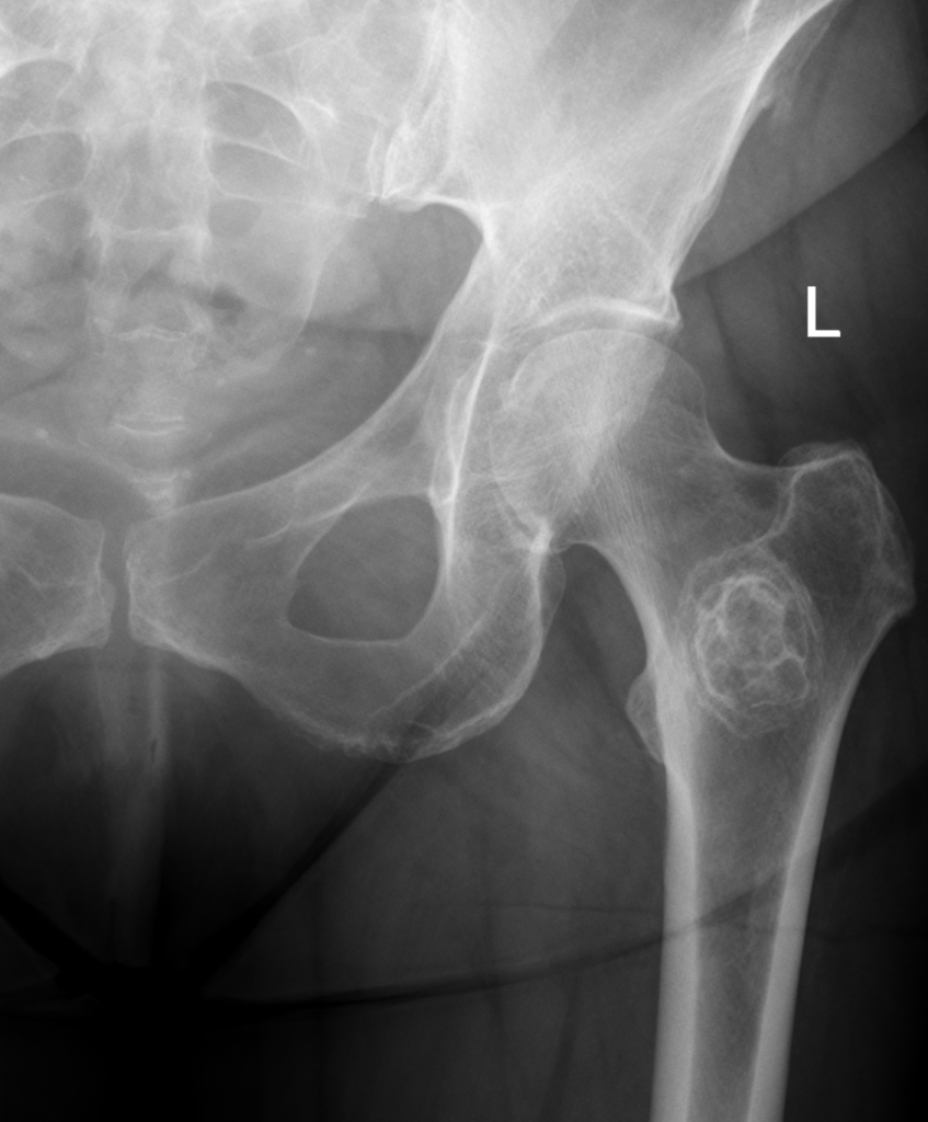 Radiograph of the proximal femur