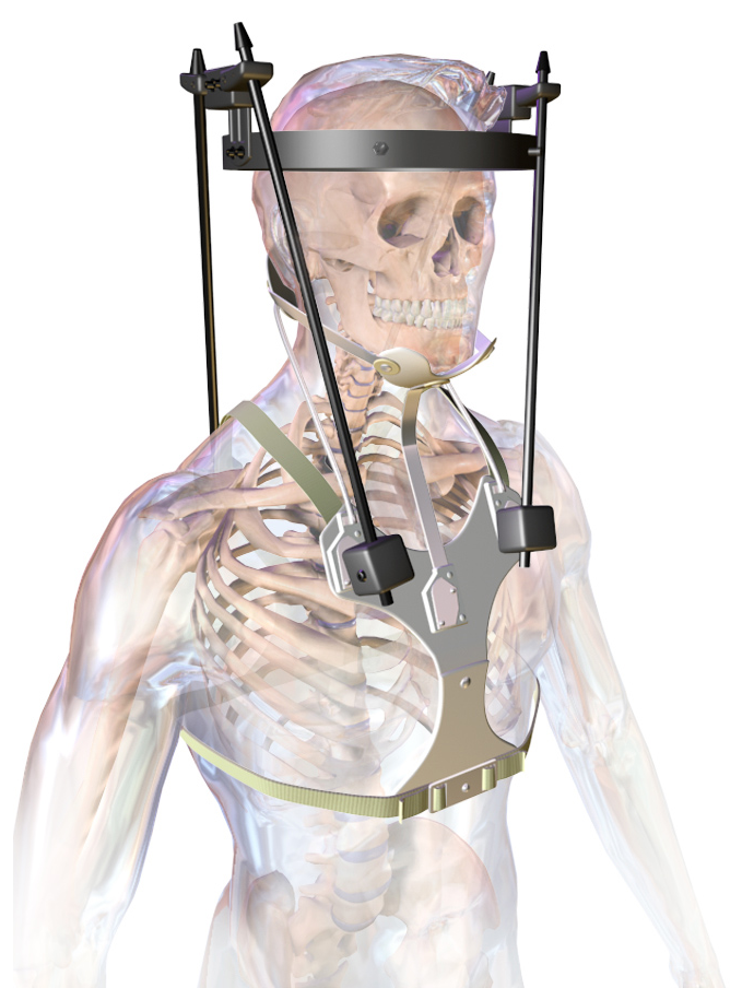 Immobilisation & Halo Application, halo brace