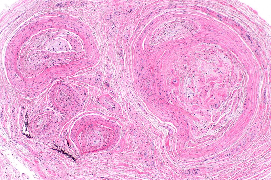 Foot Ankle iSAWE 17, histology (H and E)