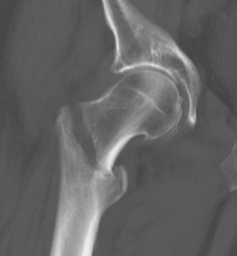 Intertrochanteric Femoral Fractures, ct of a pertrochanteric fracture