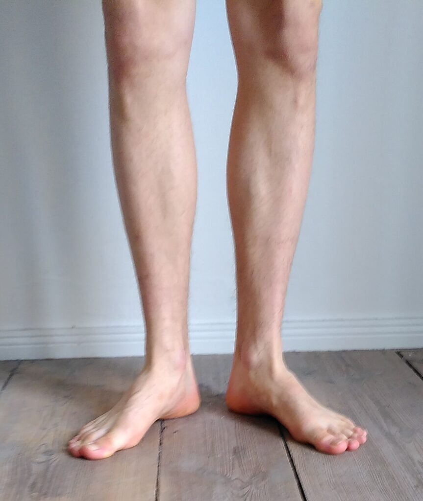 Intoeing / Out-toeing, out-toeing gait