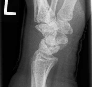 Kienbock's Disease, hand radiograph showing kienböck disease of the lunate