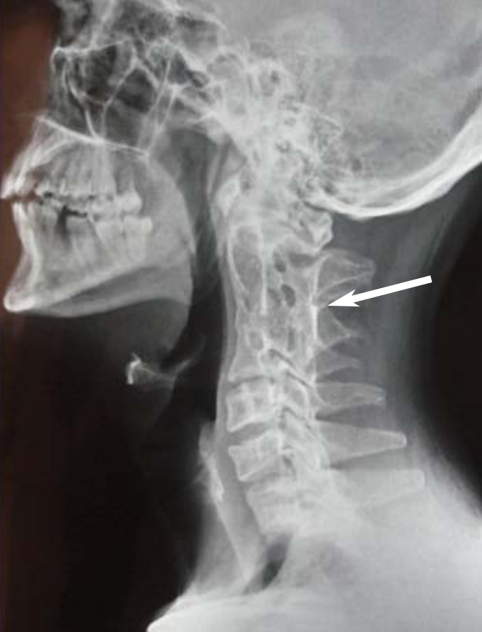 Klippel-Feil Syndrome, lateral radiograph of the cervical spine in klippel-feil syndrome