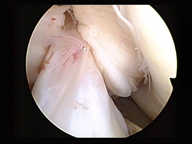 Knee iSAWE 1, arthroscopic view of the intercondylar notch