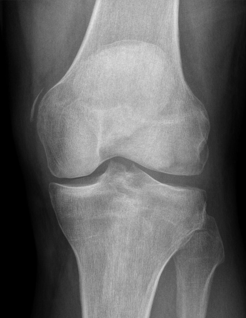 Knee iSAWE 16, AP radiograph of the knee