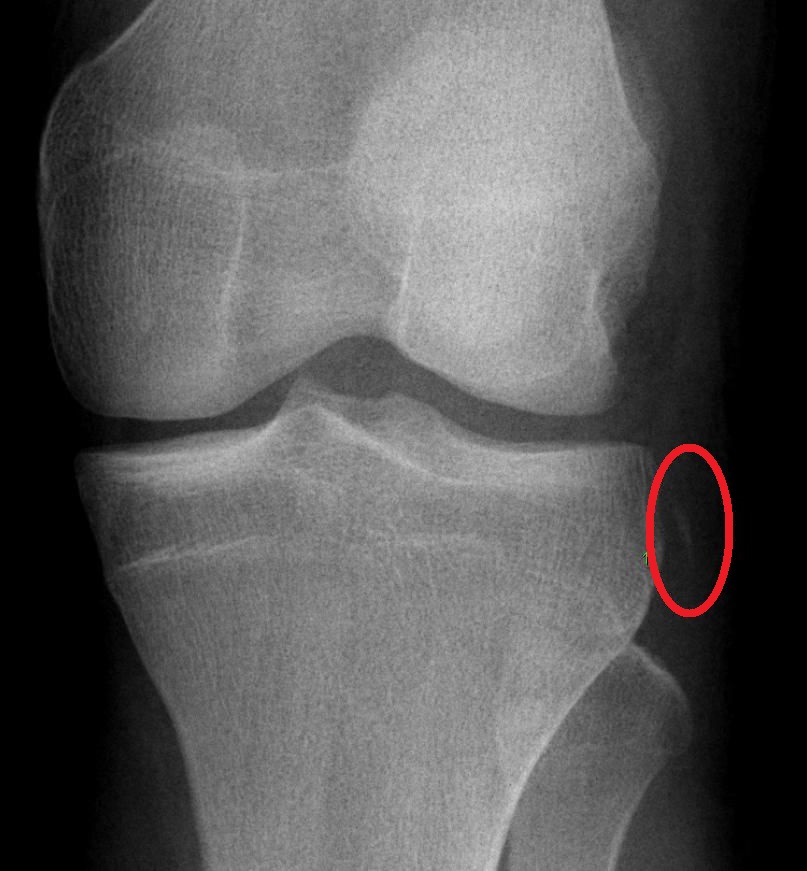 Knee iSAWE 18, AP radiograph of the knee