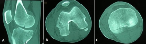 Knee iSAWE 19, coronal and axial CT of the knee