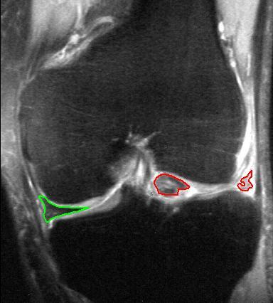 Knee iSAWE 2, coronal mri of the knee
