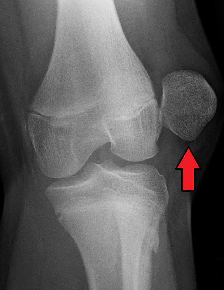 Knee iSAWE 3, ap radiograph of the knee