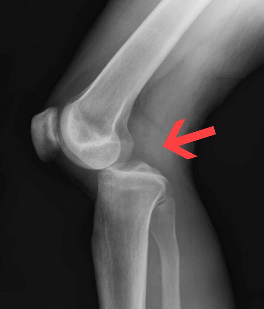Knee iSAWE 4, lateral radiograph of the knee