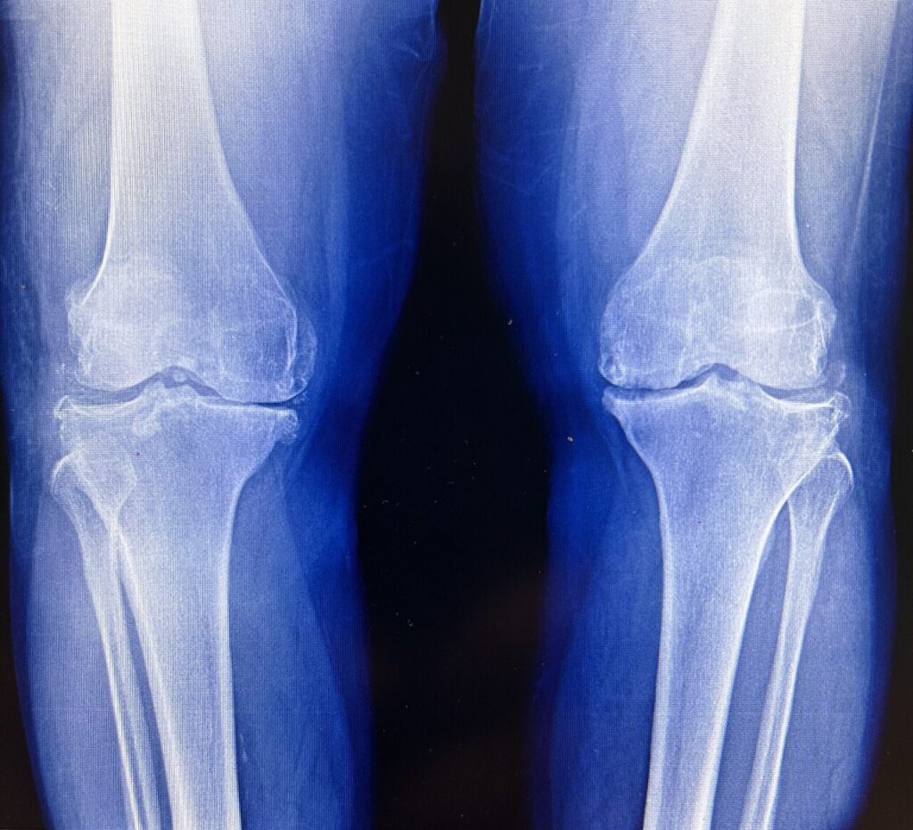 Knee iSAWE 5, standing ap radiograph of both knees