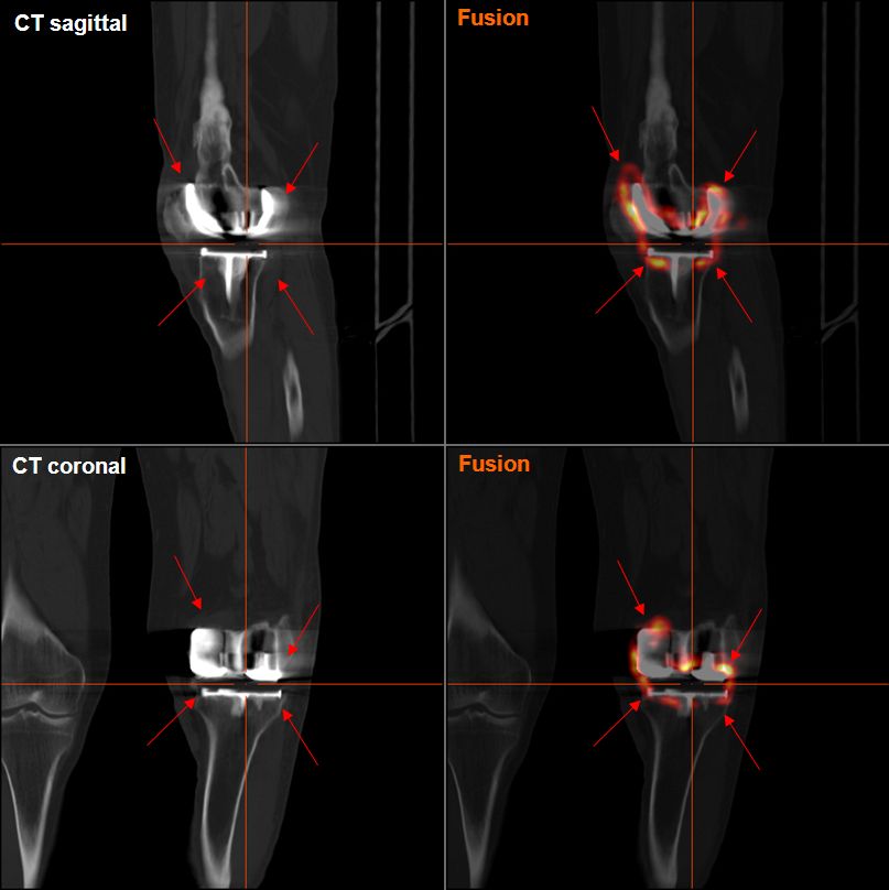 Knee iSAWE 6, ct and pet-ct of the knee