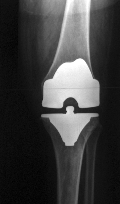 Knee iSAWE 7, ap radiograph of a total knee arthroplasty
