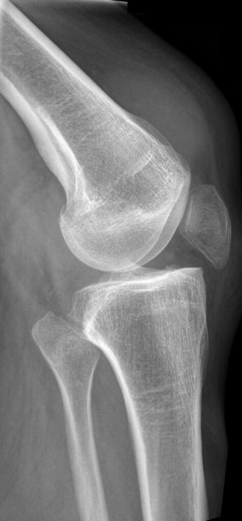 Knee iSAWE 8, lateral radiograph of the knee