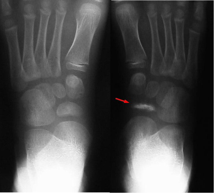 Kohler's Disease, radiograph of köhler disease of the navicular