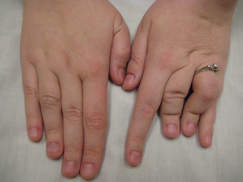 Larsen Syndrome, hands of a person with larsen syndrome