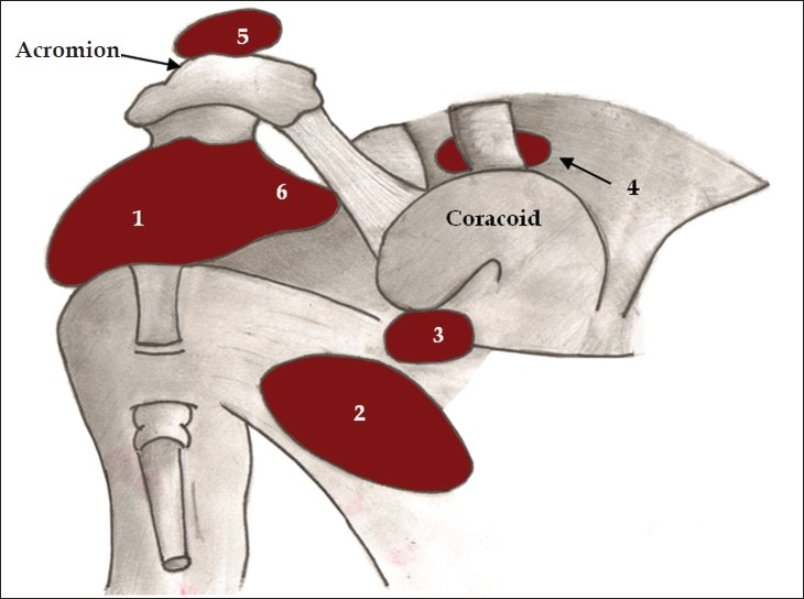 Lateral Approach to the Shoulder, bursae around the shoulder joint