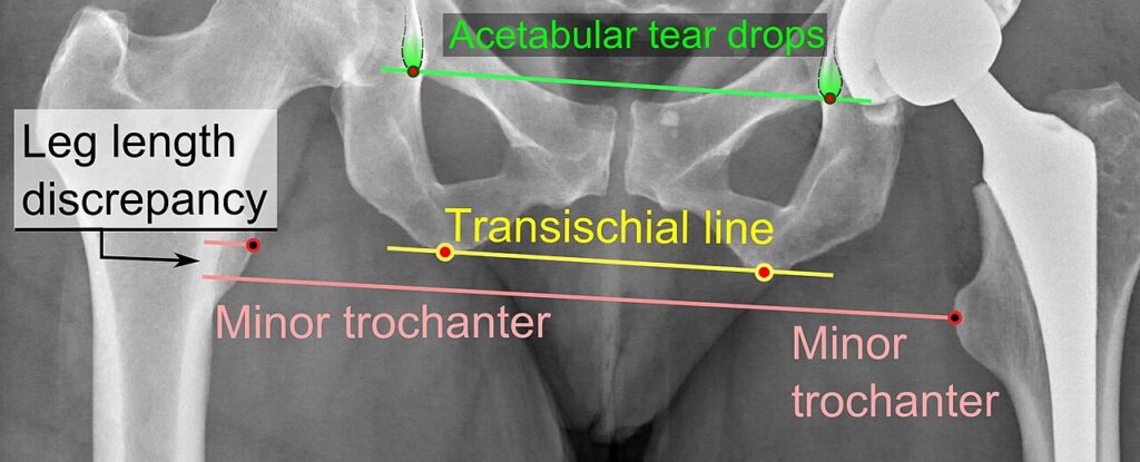Leg Length Discrepancy, pelvic radiograph showing leg length discrepancy after hip arthroplasty