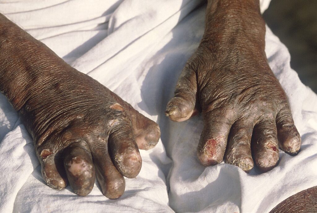 Leprosy, hand deformities in leprosy