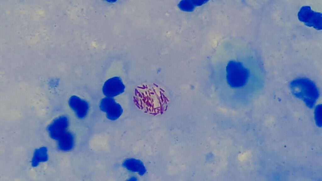 Leprosy, mycobacterium leprae on ziehl-neelsen stain
