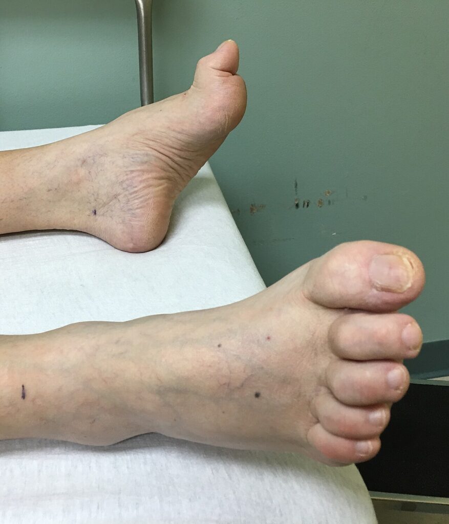 Foot Ankle iSAWE 18, clinical photograph of the feet